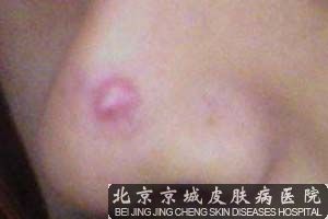 儿童毛囊炎怎么护理