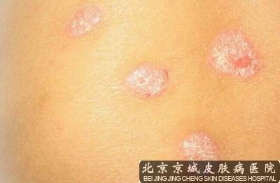京城“自血回输诊疗”带您进入规范治“癣”时代