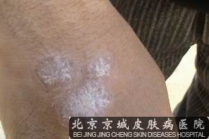 Xtrac308准分子激光，无法超越的治“屑”巅峰!