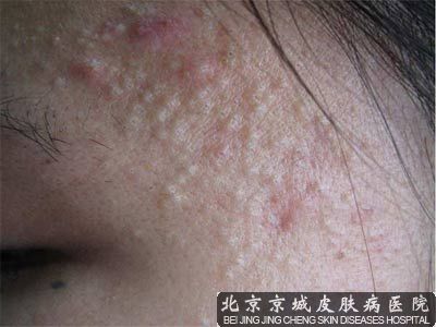怎么预防青春痘