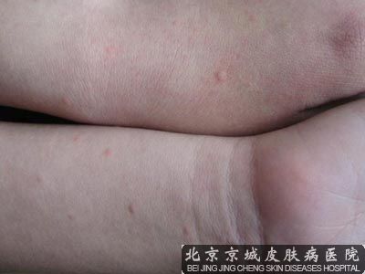 小儿荨麻疹的症状护理