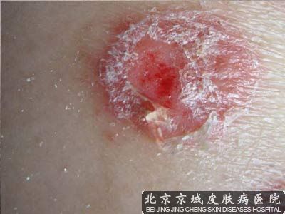 如何做好儿童牛皮癣的预防