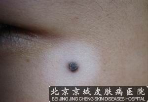 白癜风夏季怎样护理