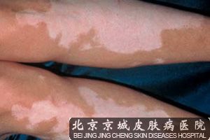 白癜风给患者带来哪些危害呢