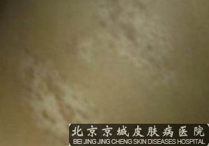 白癜风能*吗