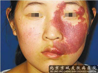 胎记出现的原因有哪些