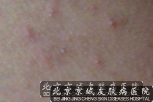 手足癣的临床症状有哪些