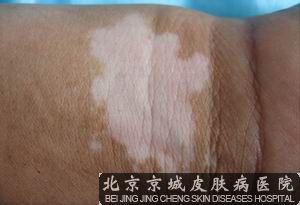 白癜风早期如何治疗