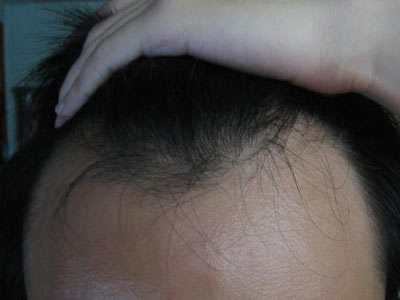 脱发有哪些护理方法