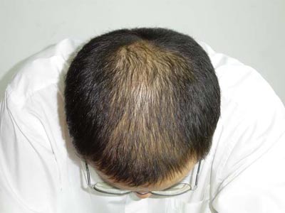 脱发的预防方法是什么