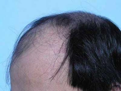 脱发的正确护理方法是什么