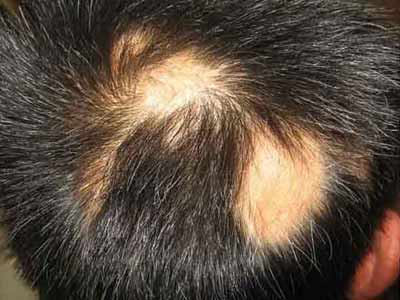 斑秃的常见症状有什么