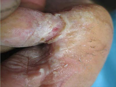 手足癣有哪些症状