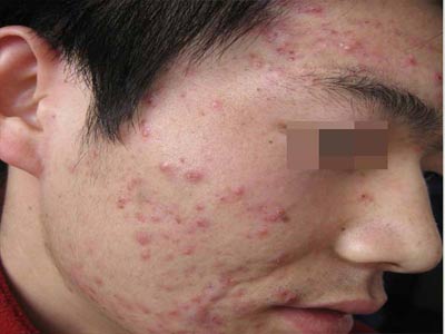 青春痘如何护理好