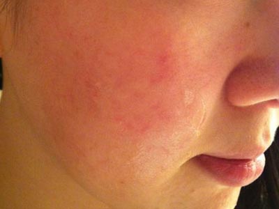 皮肤过敏是什么原因引起的
