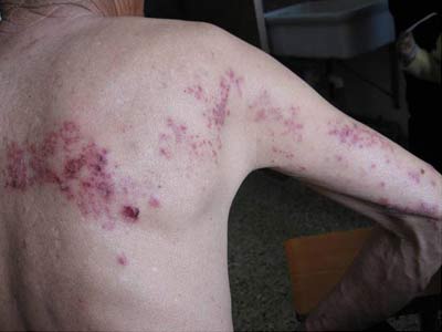 带状疱疹的常见症状是什么